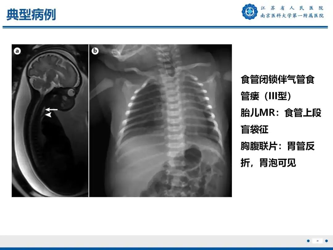 影像PPT - 【PPT】食管闭锁-29