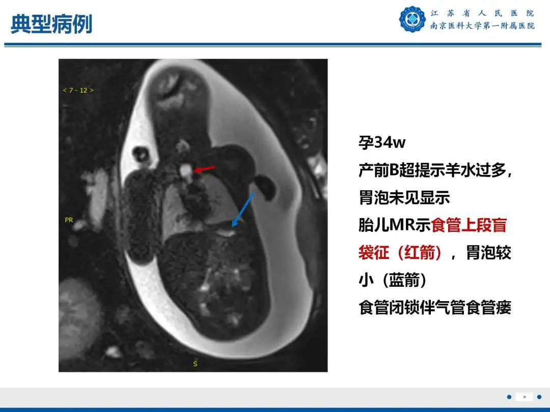 影像PPT - 【PPT】食管闭锁-30