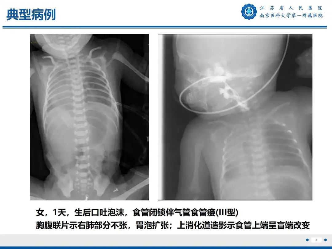 影像PPT - 【PPT】食管闭锁-31