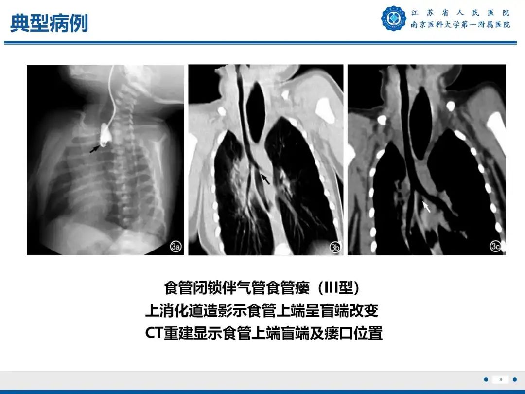 影像PPT - 【PPT】食管闭锁-32