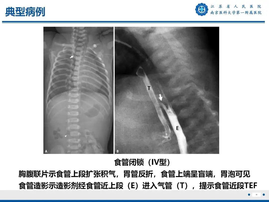 影像PPT - 【PPT】食管闭锁-33