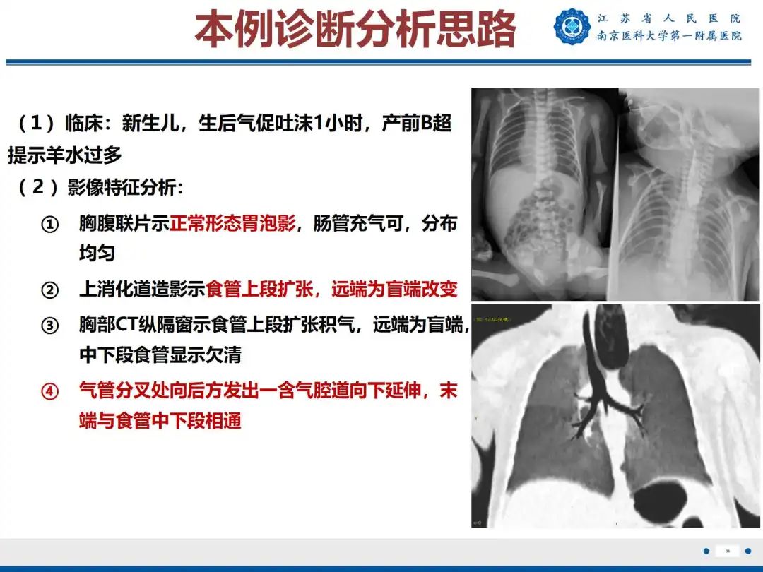 影像PPT - 【PPT】食管闭锁-34