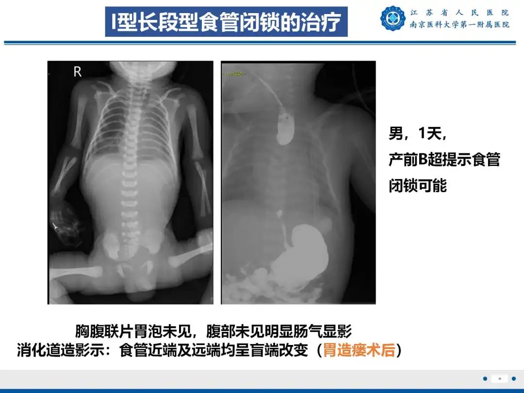 影像PPT - 【PPT】食管闭锁-36