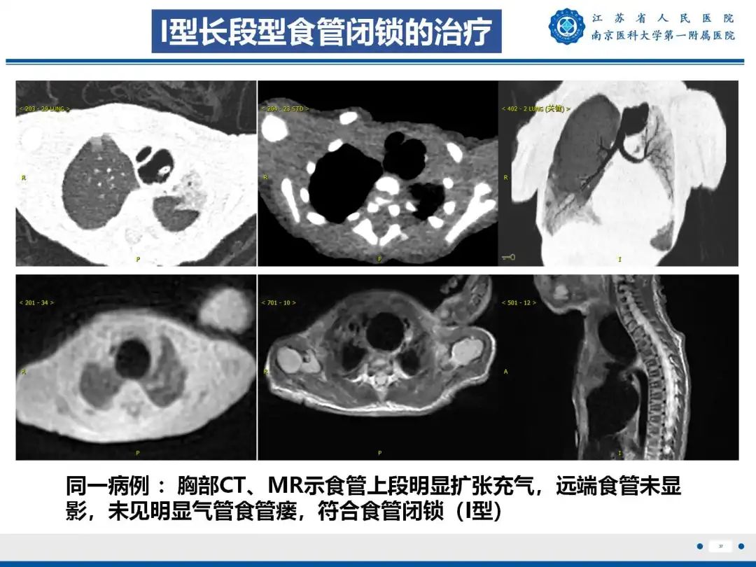 影像PPT - 【PPT】食管闭锁-37