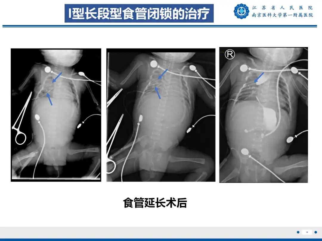 影像PPT - 【PPT】食管闭锁-38