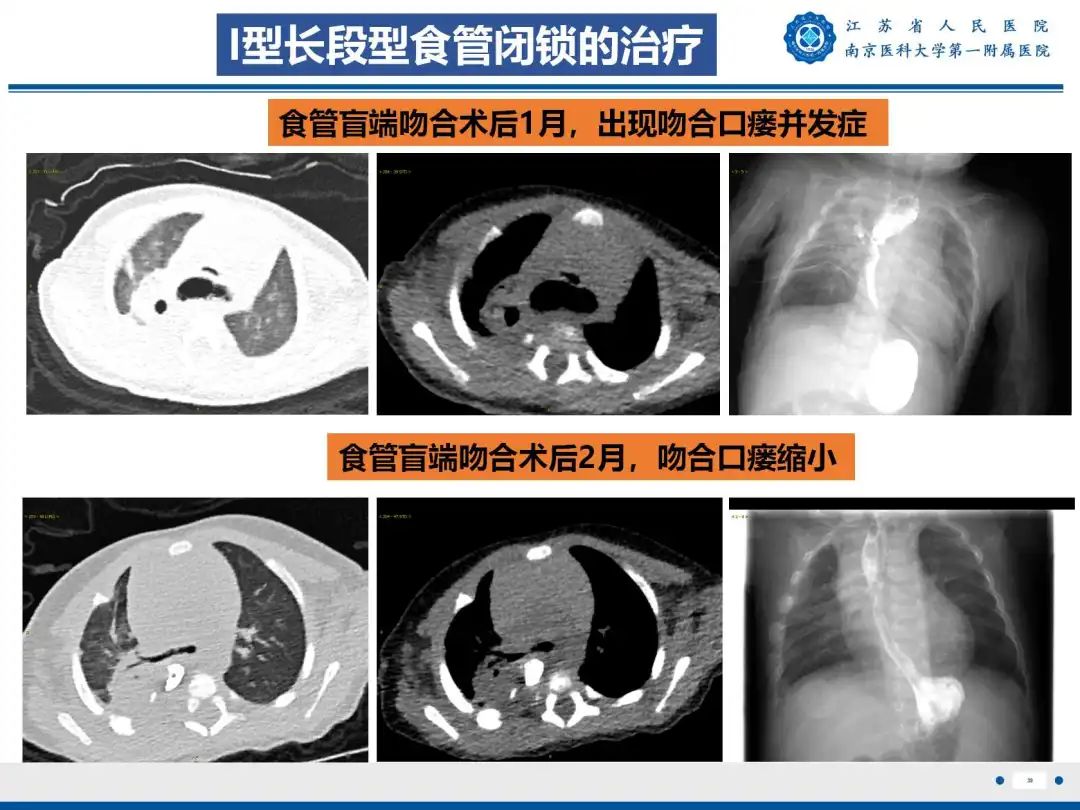 影像PPT - 【PPT】食管闭锁-39