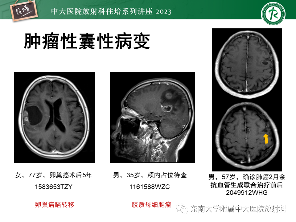 影像PPT - 【PPT】颅内常见肿瘤性囊性病变-5