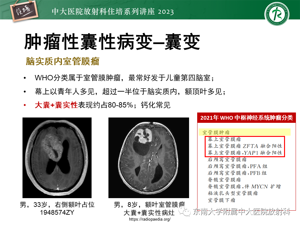 影像PPT - 【PPT】颅内常见肿瘤性囊性病变-6