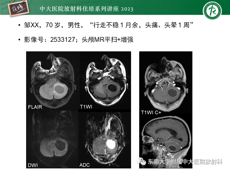 影像PPT - 【PPT】颅内常见肿瘤性囊性病变-7