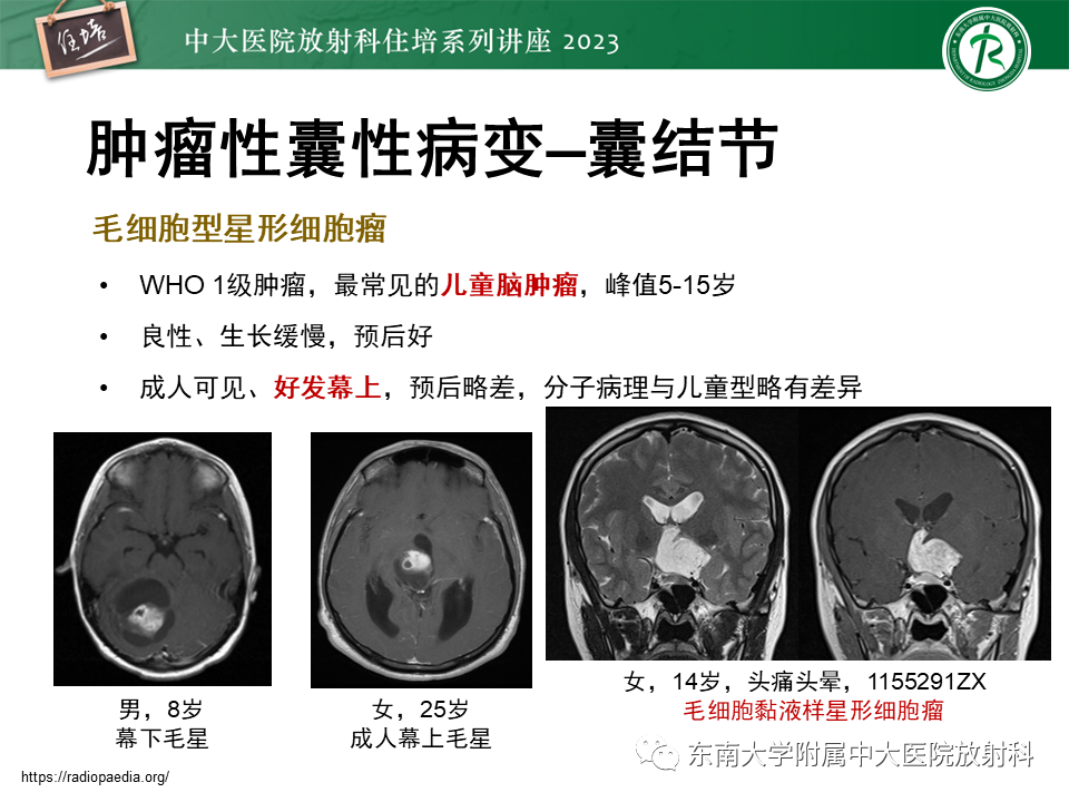 影像PPT - 【PPT】颅内常见肿瘤性囊性病变-12