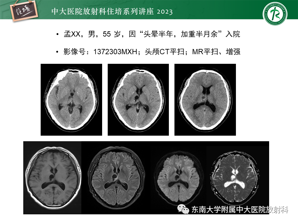 影像PPT - 【PPT】颅内常见肿瘤性囊性病变-13