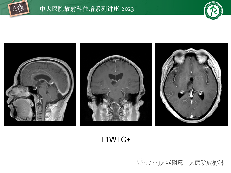 影像PPT - 【PPT】颅内常见肿瘤性囊性病变-14