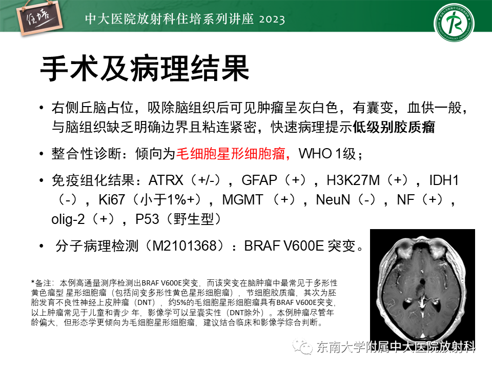 影像PPT - 【PPT】颅内常见肿瘤性囊性病变-15