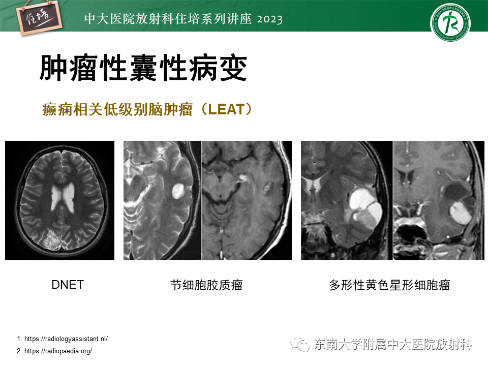 影像PPT - 【PPT】颅内常见肿瘤性囊性病变-19