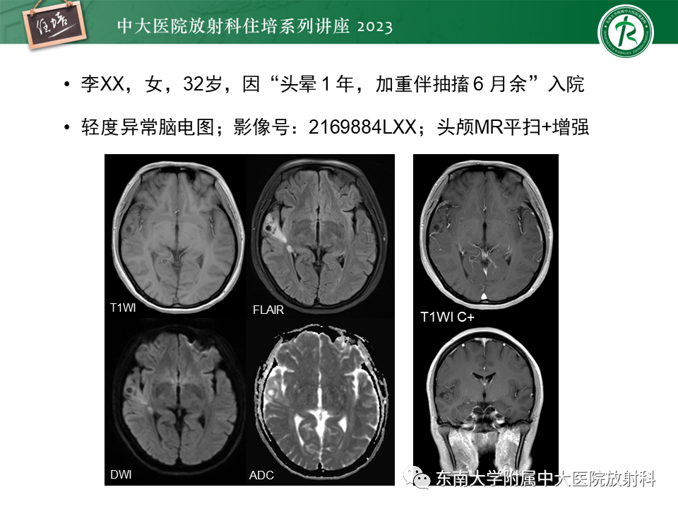 影像PPT - 【PPT】颅内常见肿瘤性囊性病变-20