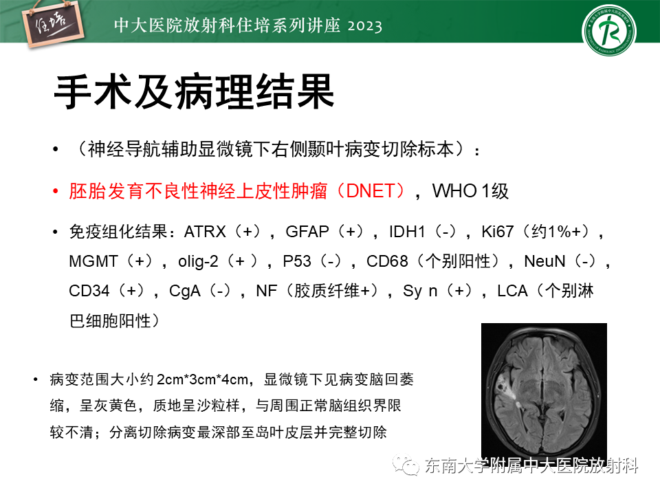 影像PPT - 【PPT】颅内常见肿瘤性囊性病变-21