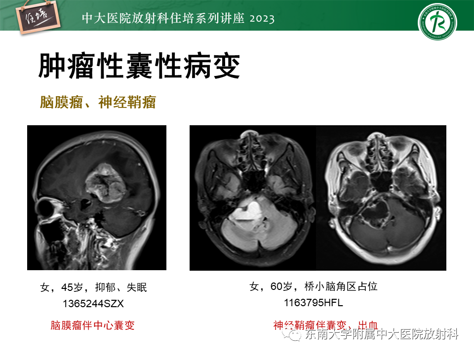 影像PPT - 【PPT】颅内常见肿瘤性囊性病变-25