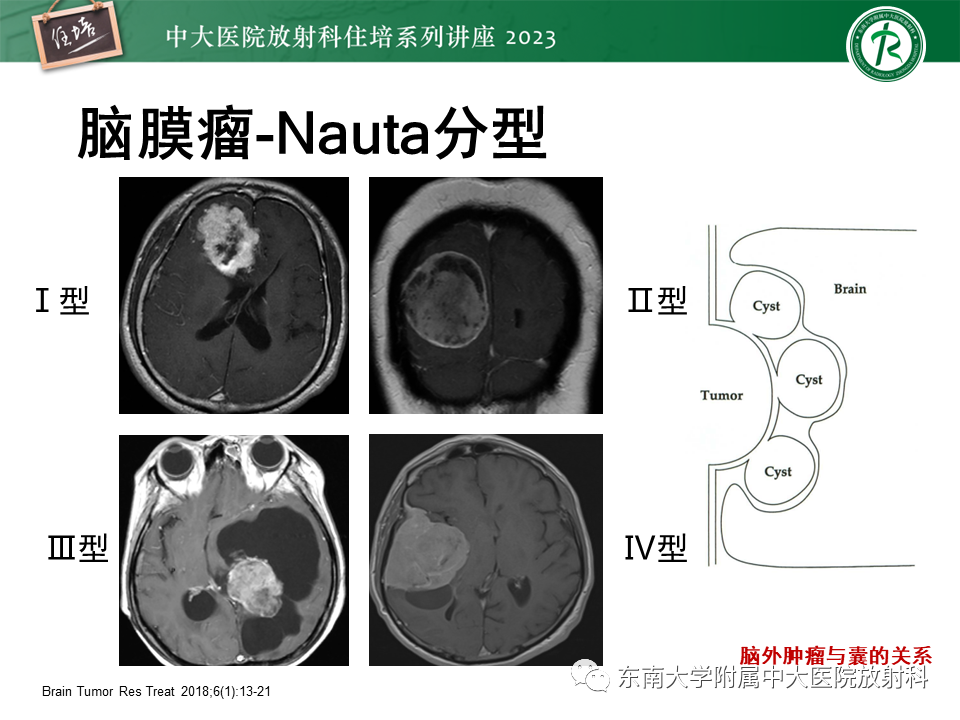 影像PPT - 【PPT】颅内常见肿瘤性囊性病变-29