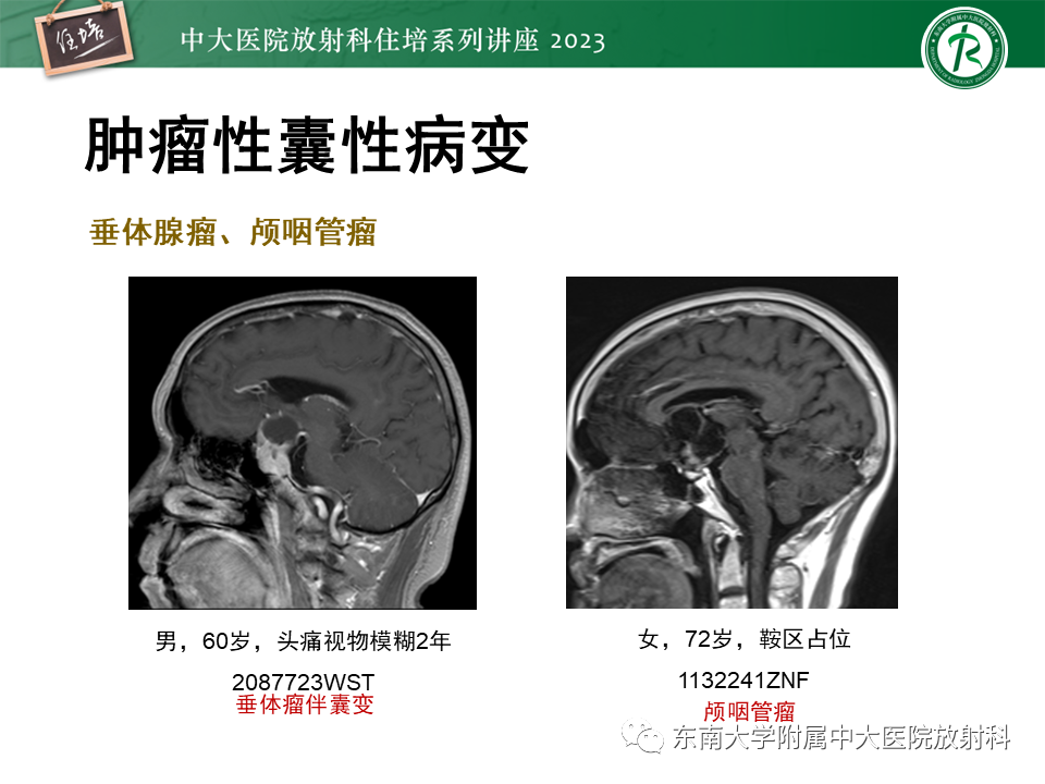 影像PPT - 【PPT】颅内常见肿瘤性囊性病变-31