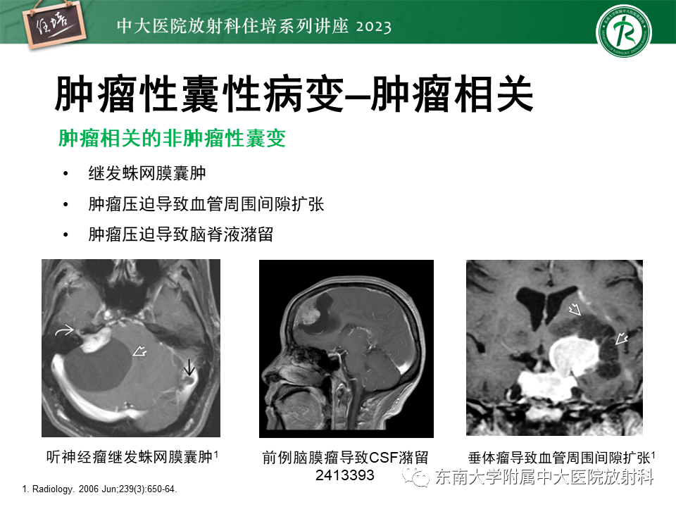 影像PPT - 【PPT】颅内常见肿瘤性囊性病变-33