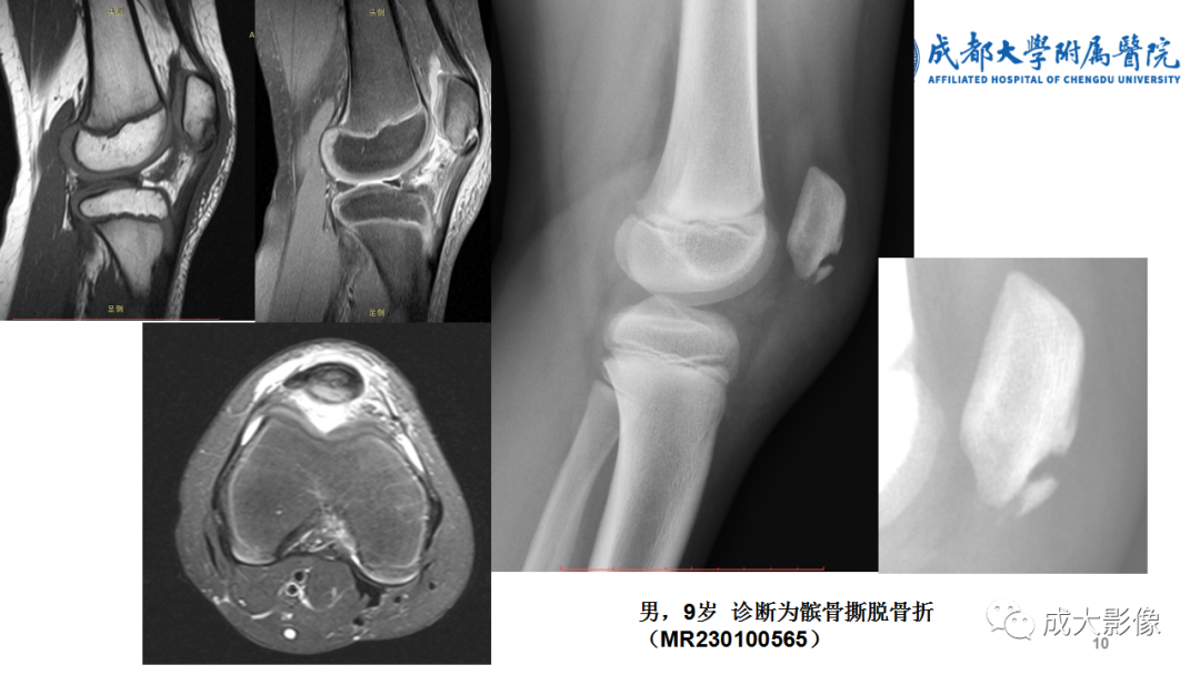 影像PPT - 【PPT】髌骨袖套状撕脱性骨折-10