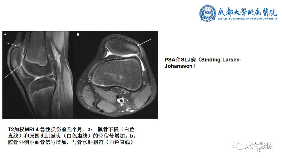 影像PPT - 【PPT】髌骨袖套状撕脱性骨折-12
