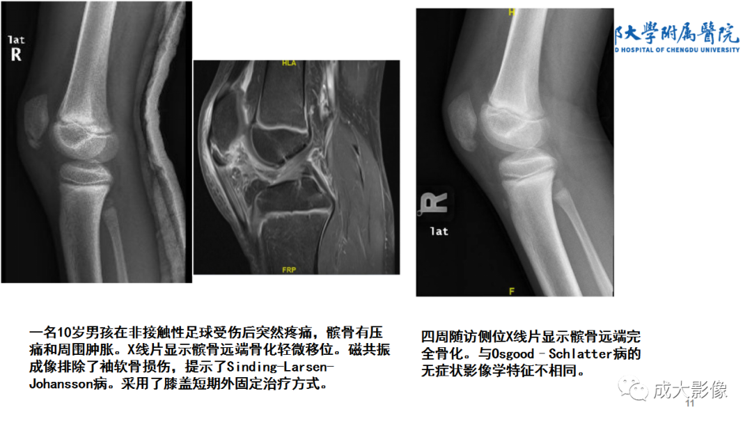 影像PPT - 【PPT】髌骨袖套状撕脱性骨折-11