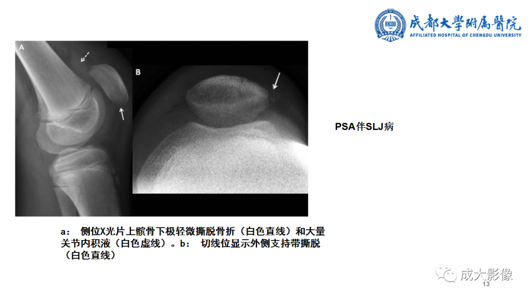 影像PPT - 【PPT】髌骨袖套状撕脱性骨折-13