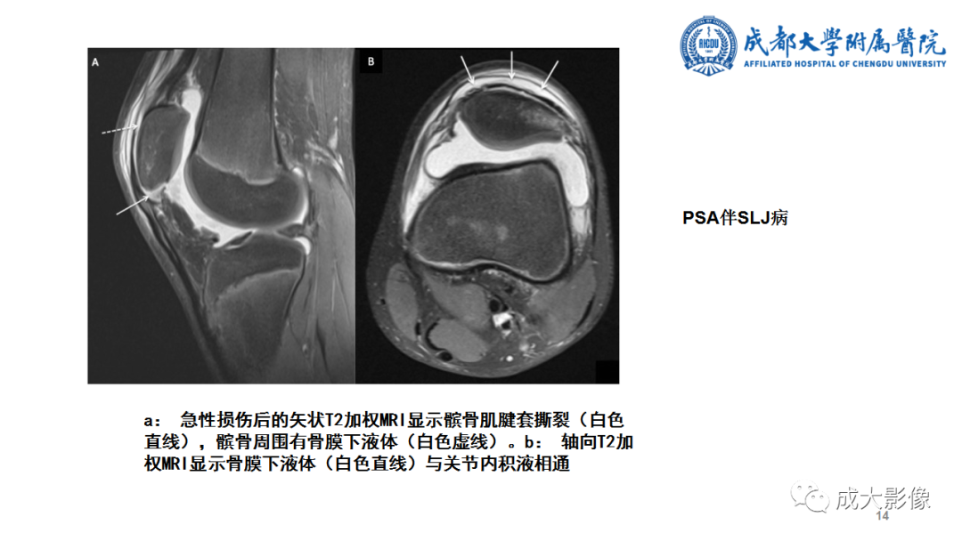 影像PPT - 【PPT】髌骨袖套状撕脱性骨折-14