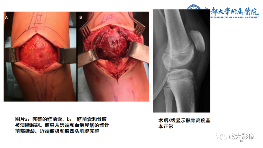 影像PPT - 【PPT】髌骨袖套状撕脱性骨折-15