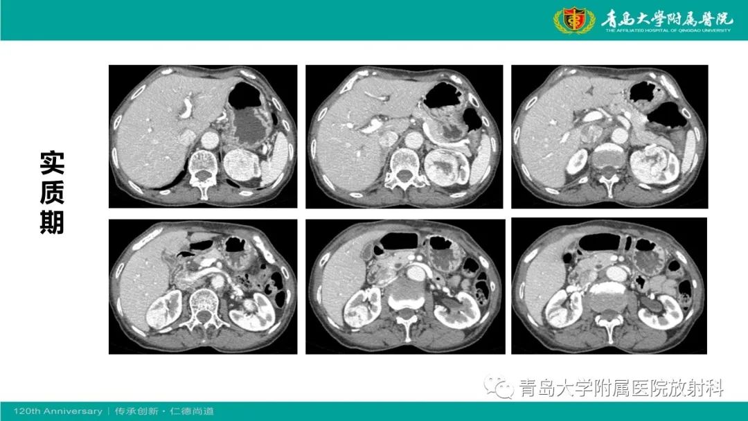 影像PPT - 【病例】肾脏嗜酸性细胞腺瘤1例CT影像-5