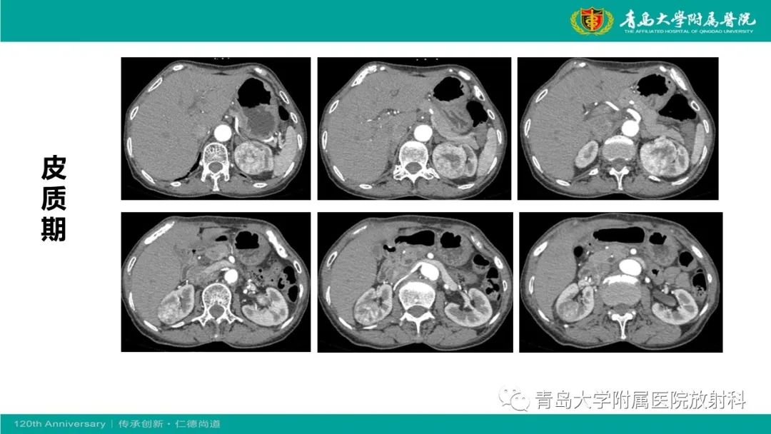 影像PPT - 【病例】肾脏嗜酸性细胞腺瘤1例CT影像-4