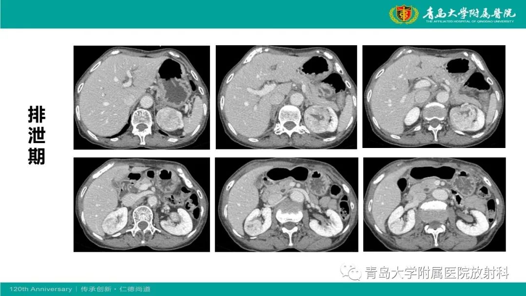 影像PPT - 【病例】肾脏嗜酸性细胞腺瘤1例CT影像-6