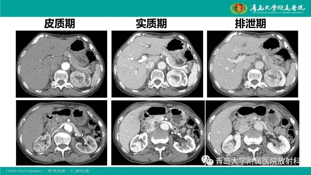 影像PPT - 【病例】肾脏嗜酸性细胞腺瘤1例CT影像-7