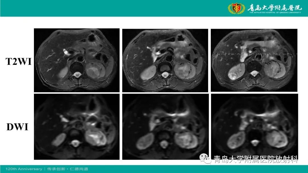 影像PPT - 【病例】肾脏嗜酸性细胞腺瘤1例CT影像-8