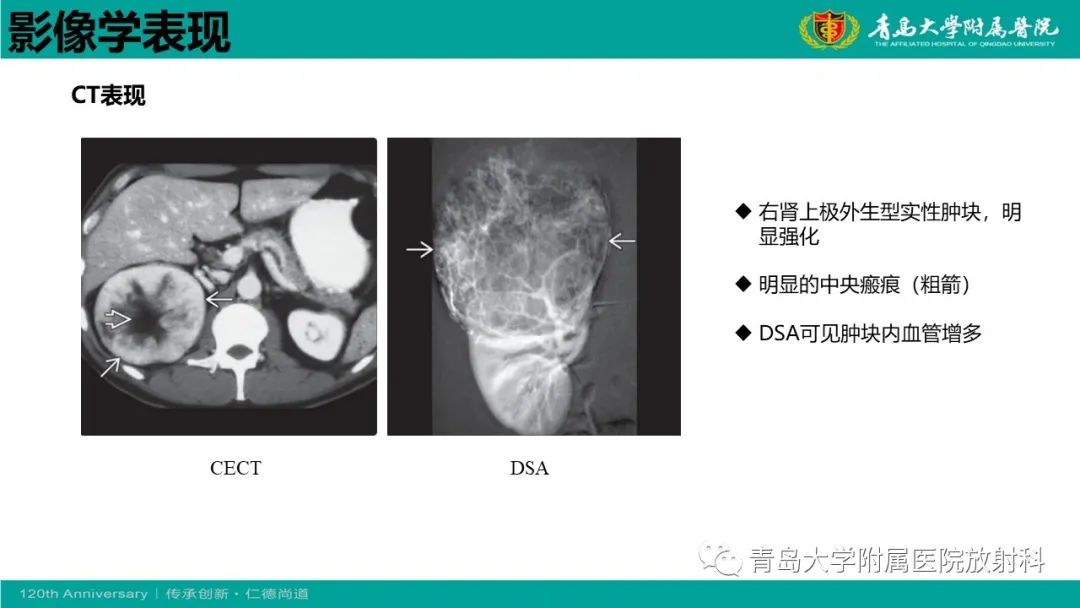影像PPT - 【病例】肾脏嗜酸性细胞腺瘤1例CT影像-18