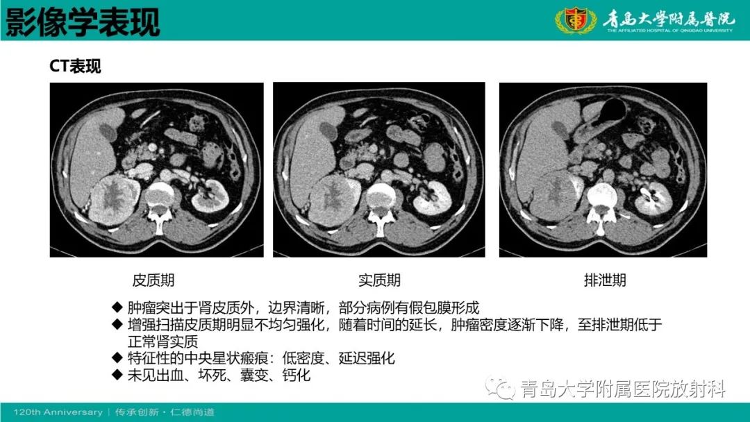 影像PPT - 【病例】肾脏嗜酸性细胞腺瘤1例CT影像-17