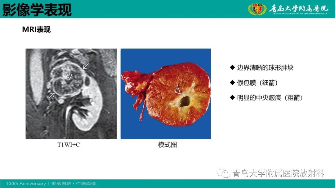 影像PPT - 【病例】肾脏嗜酸性细胞腺瘤1例CT影像-19