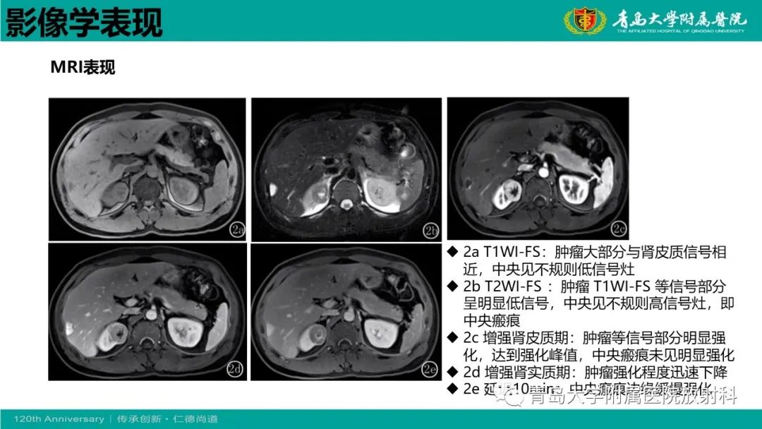 影像PPT - 【病例】肾脏嗜酸性细胞腺瘤1例CT影像-20
