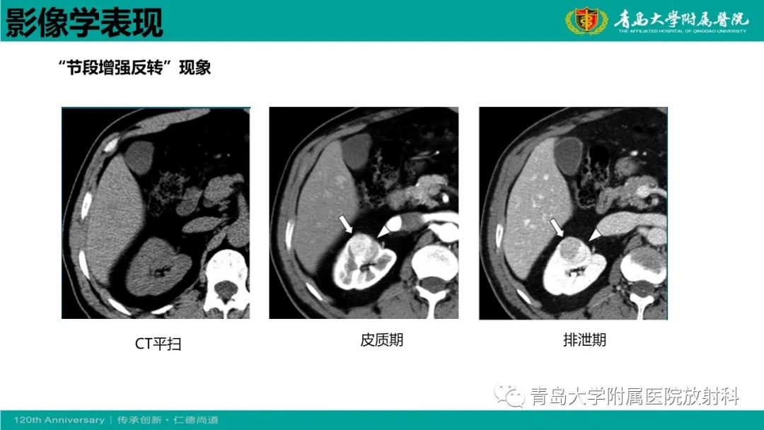 影像PPT - 【病例】肾脏嗜酸性细胞腺瘤1例CT影像-22