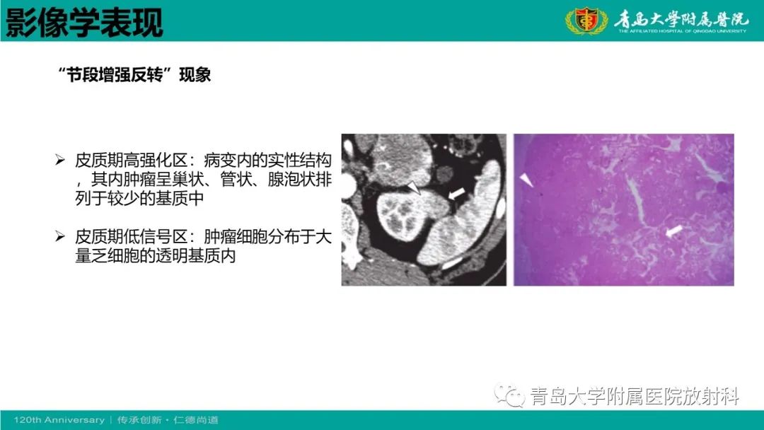 影像PPT - 【病例】肾脏嗜酸性细胞腺瘤1例CT影像-23