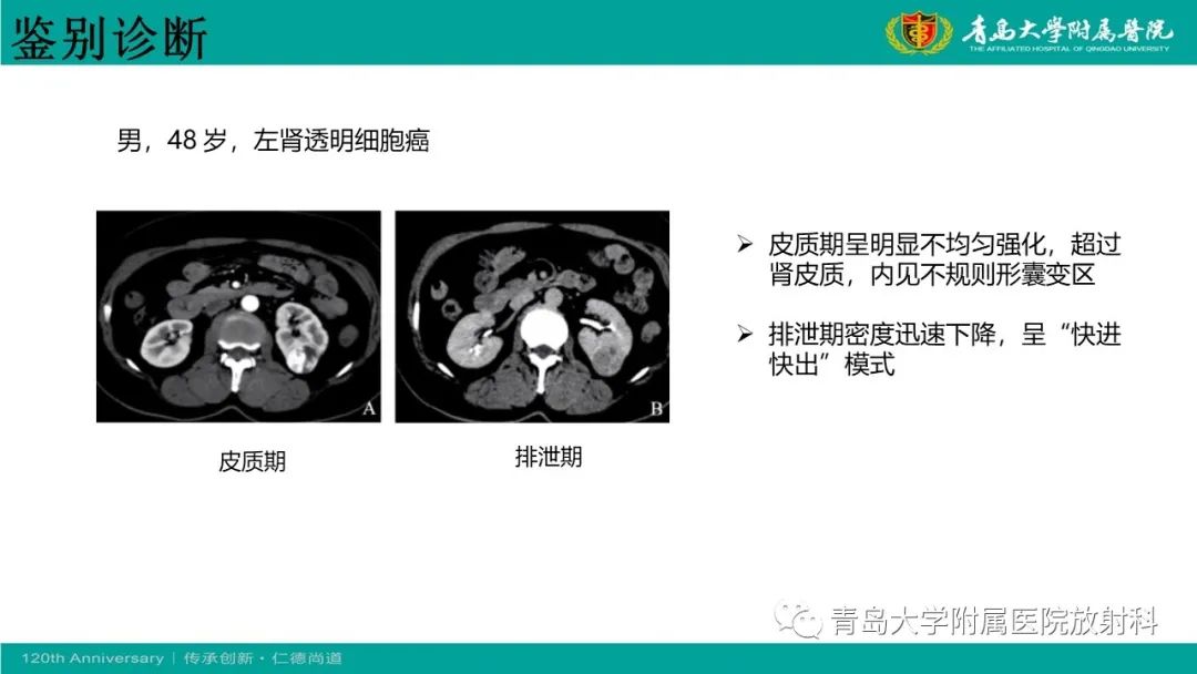 影像PPT - 【病例】肾脏嗜酸性细胞腺瘤1例CT影像-26