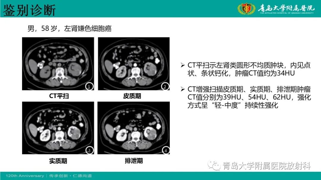 影像PPT - 【病例】肾脏嗜酸性细胞腺瘤1例CT影像-28