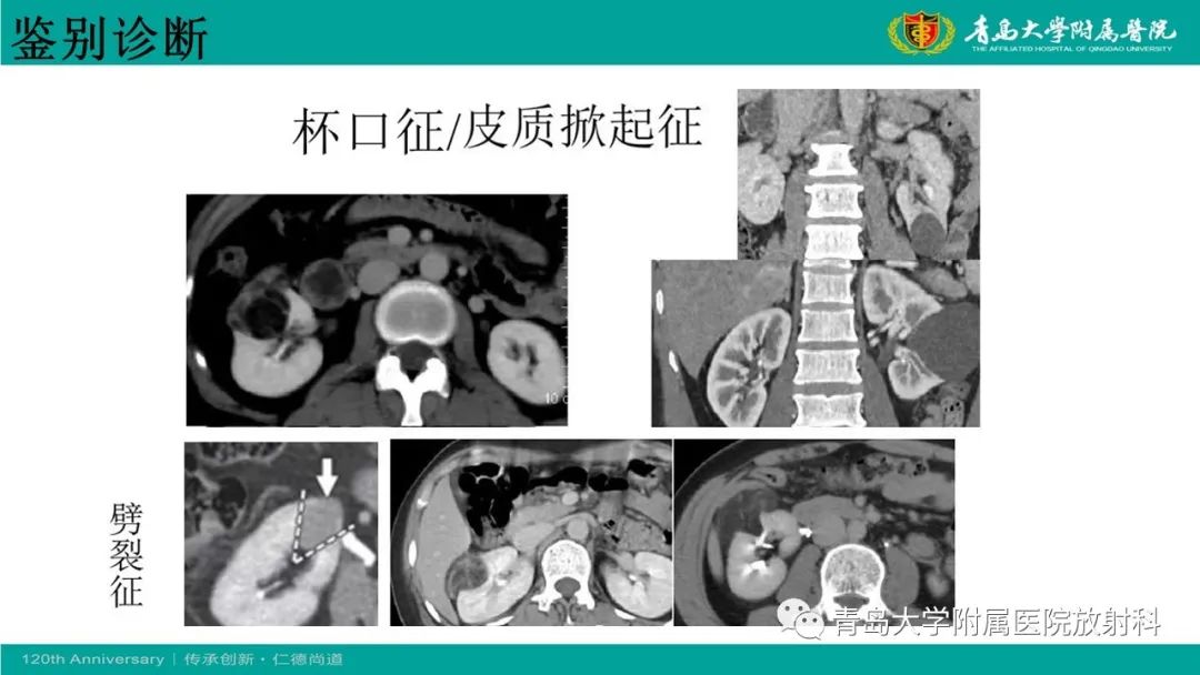 影像PPT - 【病例】肾脏嗜酸性细胞腺瘤1例CT影像-30
