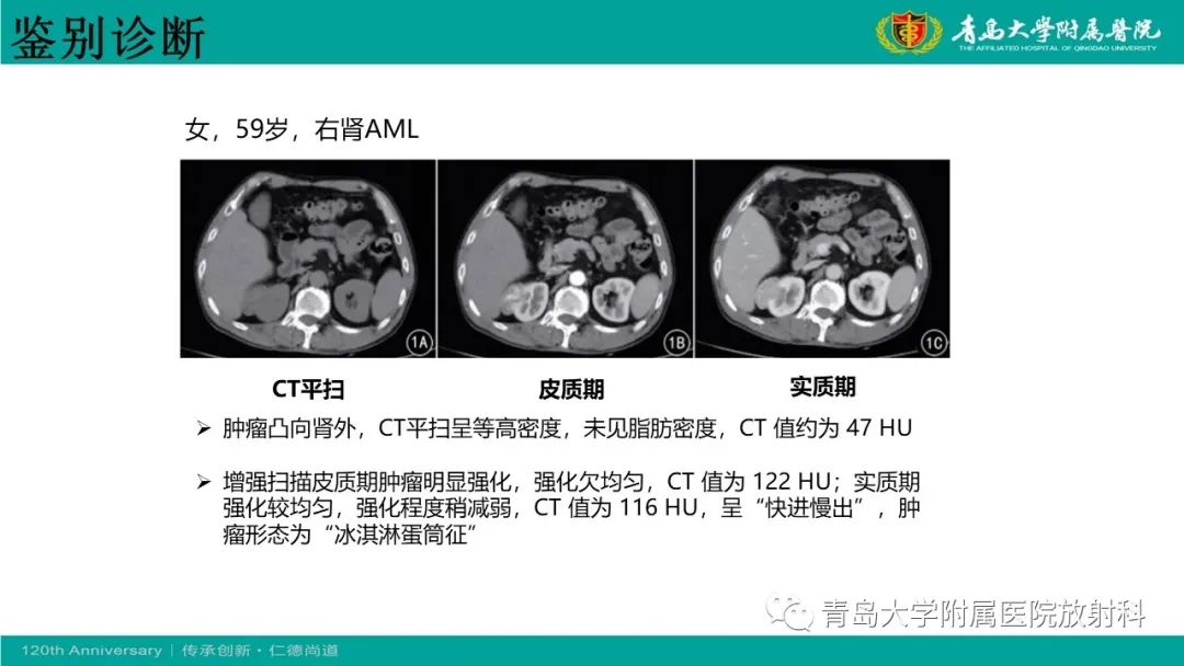 影像PPT - 【病例】肾脏嗜酸性细胞腺瘤1例CT影像-31