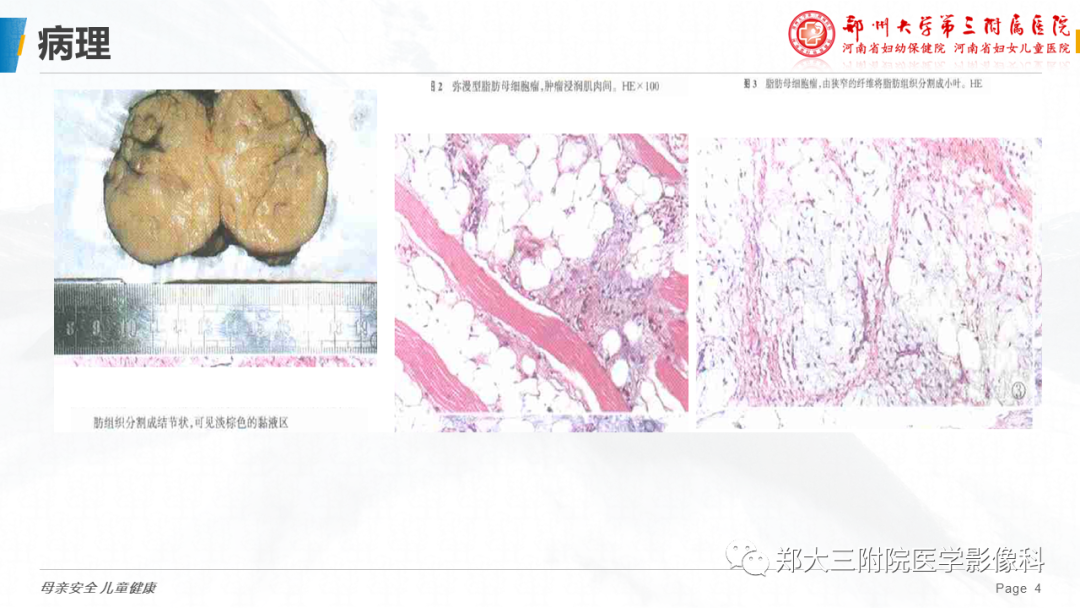 影像PPT - 【PPT】脂肪母细胞瘤的影像诊断-4