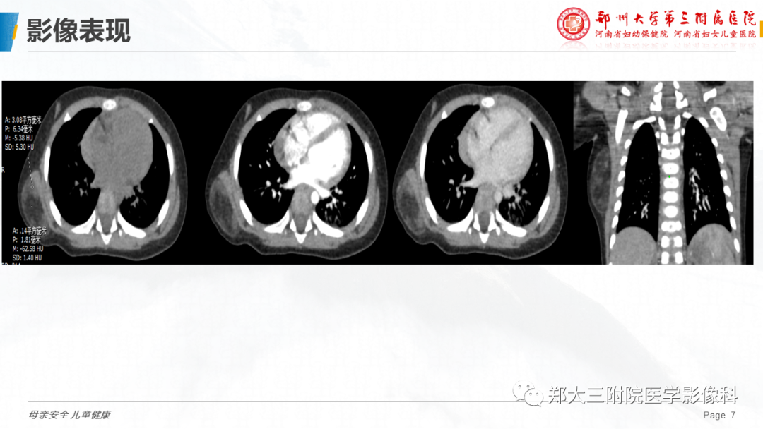 影像PPT - 【PPT】脂肪母细胞瘤的影像诊断-7