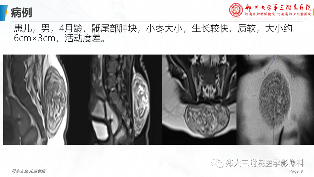 影像PPT - 【PPT】脂肪母细胞瘤的影像诊断-8