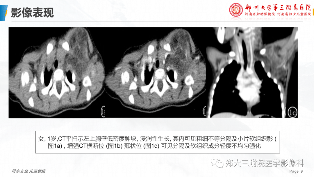 影像PPT - 【PPT】脂肪母细胞瘤的影像诊断-9