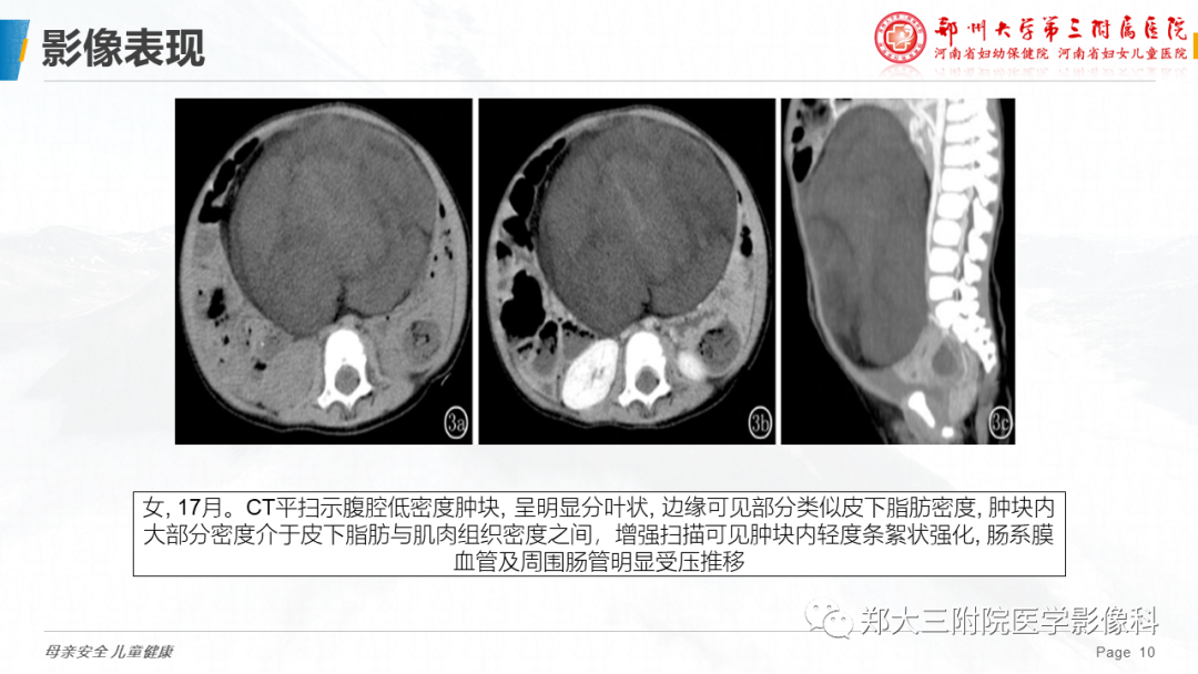 影像PPT - 【PPT】脂肪母细胞瘤的影像诊断-10